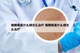 纏腰癬是什么病怎么治療 纏腰癬是什么病怎么治療