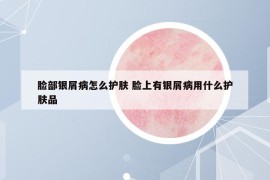 臉部銀屑病怎么護膚 臉上有銀屑病用什么護膚品