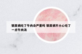 銀屑病吃了牛肉會嚴(yán)重嗎 銀屑病不小心吃了一點(diǎn)牛肉湯