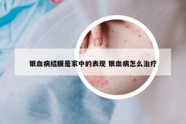 銀血病結(jié)膜是家中的表現(xiàn) 銀血病怎么治療