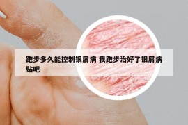 跑步多久能控制銀屑病 我跑步治好了銀屑病貼吧