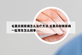 毛囊炎銀屑病怎么治療方法 毛囊炎和銀屑病一起發(fā)生怎么回事