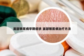 面部銀屑病早期癥狀 面部銀屑病治療方法