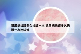 銀屑病拔罐多久拔罐一次 銀屑病拔罐多久拔罐一次比較好