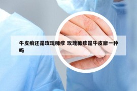 牛皮癬還是玫瑰糠疹 玫瑰糠疹是牛皮廨一種嗎