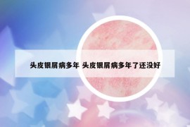 頭皮銀屑病多年 頭皮銀屑病多年了還沒好