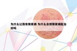 為什么讓我有銀屑病 為什么會(huì)得銀屑病能治好嗎