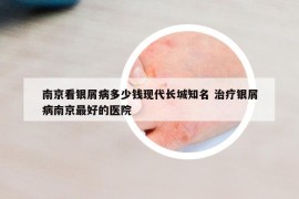 南京看銀屑病多少錢(qián)現(xiàn)代長(zhǎng)城知名 治療銀屑病南京最好的醫(yī)院