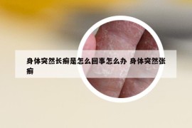 身體突然長(zhǎng)癬是怎么回事怎么辦 身體突然張癬