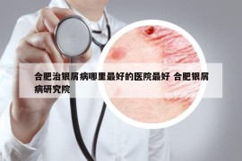 合肥治銀屑病哪里最好的醫(yī)院最好 合肥銀屑病研究院