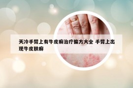 天冷手臂上有牛皮癬治療偏方大全 手臂上出現(xiàn)牛皮膚癬