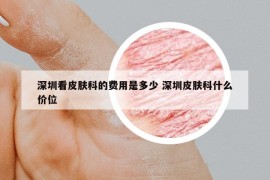 深圳看皮膚科的費(fèi)用是多少 深圳皮膚科什么價(jià)位