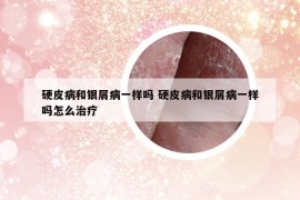 硬皮病和銀屑病一樣嗎 硬皮病和銀屑病一樣嗎怎么治療