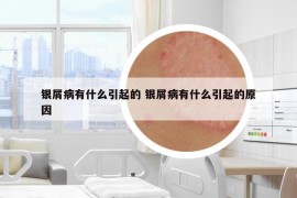 銀屑病有什么引起的 銀屑病有什么引起的原因
