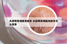 頭部銀屑病越來越多 頭部銀屑病越來越多怎么回事