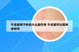牛皮癬用干粉有什么副作用 牛皮癬可以用爽身粉嗎