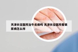 天津長征醫(yī)院治牛皮癬嗎 天津長征醫(yī)院看銀屑病怎么樣