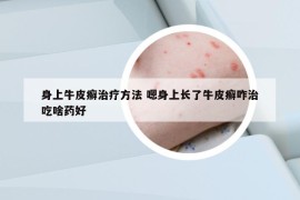 身上牛皮癬治療方法 嗯身上長(zhǎng)了牛皮癬咋治吃啥藥好