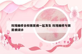 玫瑰糠疹會(huì)和銀屑病一起發(fā)生 玫瑰糠疹與銀屑病誤診
