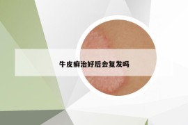 牛皮癬治好后會復(fù)發(fā)嗎
