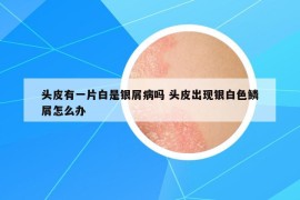 頭皮有一片白是銀屑病嗎 頭皮出現(xiàn)銀白色鱗屑怎么辦
