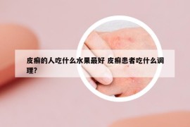 皮癬的人吃什么水果最好 皮癬患者吃什么調(diào)理?