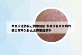 家里沒遺傳自己得銀屑病 家里沒有銀屑病的基因孩子為什么會得銀屑病啊