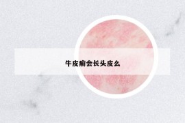 牛皮癬會(huì)長(zhǎng)頭皮么
