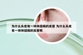 為什么頭皮有一塊塊結(jié)痂的皮屑 為什么頭皮有一塊塊結(jié)痂的皮屑呢