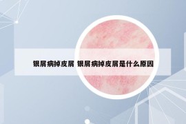 銀屑病掉皮屑 銀屑病掉皮屑是什么原因
