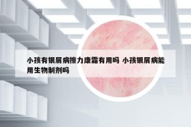 小孩有銀屑病擦力康霜有用嗎 小孩銀屑病能用生物制劑嗎
