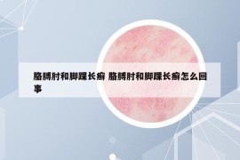 胳膊肘和腳踝長癬 胳膊肘和腳踝長癬怎么回事