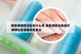 銀屑病病理活檢有什么用 銀屑病做活體組織病理檢查準(zhǔn)確率是多少