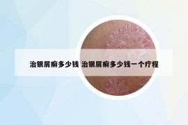 治銀屑癬多少錢 治銀屑癬多少錢一個(gè)療程