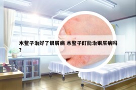 木鱉子治好了銀屑病 木鱉子酊能治銀屑病嗎?