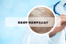 銀屑病甲 銀屑病甲怎么治療