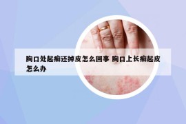 胸口處起癬還掉皮怎么回事 胸口上長(zhǎng)癬起皮怎么辦