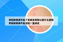 掌跖膿皰病不起了皮膚出現(xiàn)裂口是什么原因 掌跖膿皰病不起泡后一直掉皮