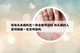 和有頭皮癬的在一塊會被傳染嗎 和頭癬的人密切接觸一定會傳染嗎