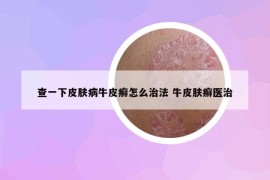 查一下皮膚病牛皮癬怎么治法 牛皮膚癬醫(yī)治