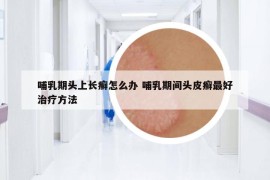 哺乳期頭上長(zhǎng)癬怎么辦 哺乳期間頭皮癬最好治療方法