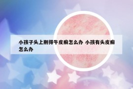 小孩子頭上剛得牛皮癬怎么辦 小孩有頭皮癬怎么辦