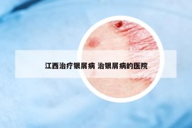 江西治療銀屑病 治銀屑病的醫(yī)院