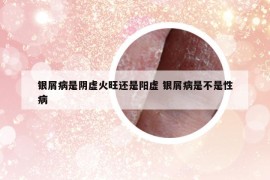 銀屑病是陰虛火旺還是陽虛 銀屑病是不是性病