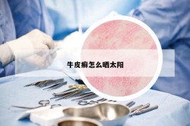 牛皮癬怎么曬太陽