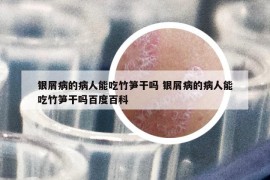 銀屑病的病人能吃竹筍干嗎 銀屑病的病人能吃竹筍干嗎百度百科