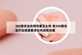 308激光治白斑效果怎么樣 用308激光治療白斑需要多長時間有效果