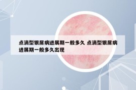 點(diǎn)滴型銀屑病進(jìn)展期一般多久 點(diǎn)滴型銀屑病進(jìn)展期一般多久出現(xiàn)