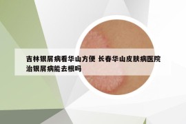 吉林銀屑病看華山方便 長春華山皮膚病醫(yī)院治銀屑病能去根嗎