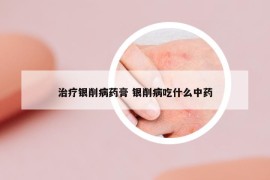 治療銀削病藥膏 銀削病吃什么中藥
